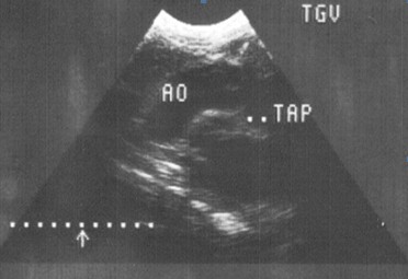 sindrome_Ivemark_isomerismo/arteria_pulmonar_aorta