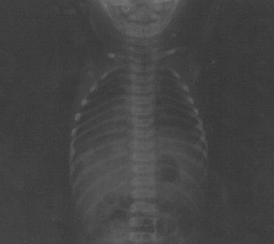 sindrome_Ivemark_isomerismo/dextrocardia_higado_medial