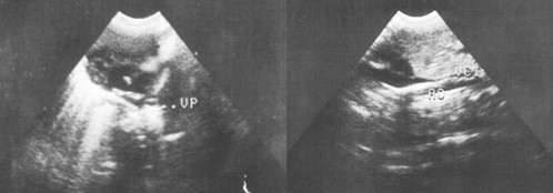 sindrome_Ivemark_isomerismo/ecografia_venas_pulmonares