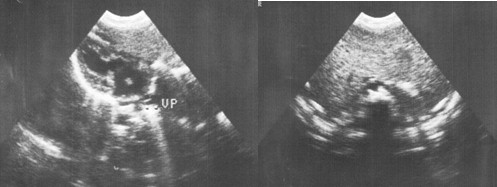 sindrome_Ivemark_isomerismo/situs_ambiguus_ambiguos