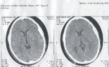 sindrome_confusional_encefalitis/TAC_RMN_imagen