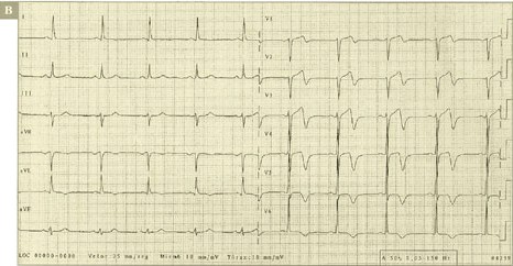sindrome_coronario_agudo/ALTERACIONES_SUGESTIVA_SEGUNDA
