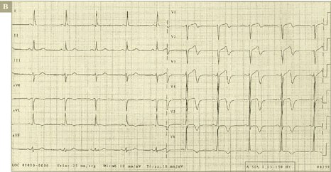 sindrome_coronario_agudo/ALTERACIONES_SUGESTIVA_SEGUNDA