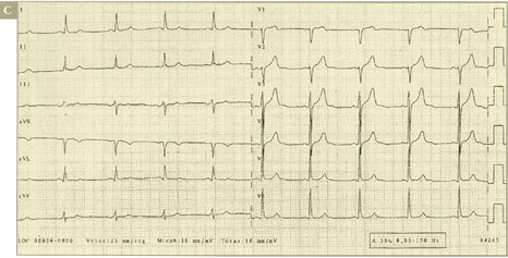 sindrome_coronario_agudo/ALTERACIONES_SUGESTIVA_TERCERA