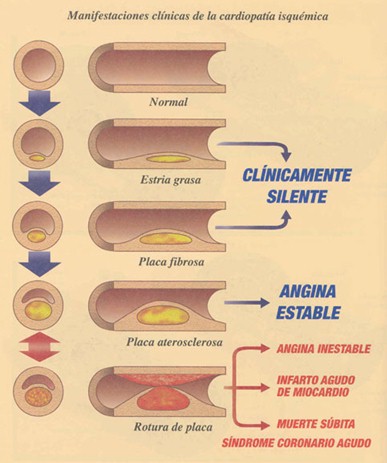 sindrome_coronario_agudo/CLINICA_CARDIOPATIA_ISQUEMICA