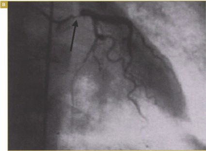 sindrome_coronario_agudo/CORONARIOGRAFIA sindrome_coronario_agudo/CORONARIOGRAFIA