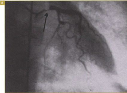 sindrome_coronario_agudo/CORONARIOGRAFIA