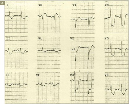 sindrome_coronario_agudo/CRITERIOS_LESION_CRITICA