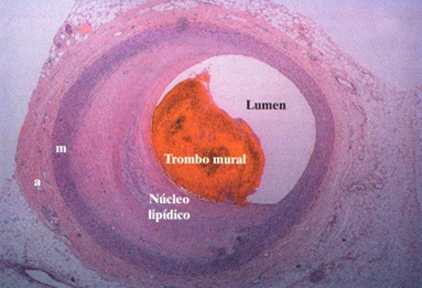 sindrome_coronario_agudo/SINDROME_CORONARIO_AGUDO