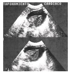 taponamiento_cardiaco_yatrogenico/grafico_derrame_2