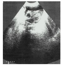 taponamiento_cardiaco_yatrogenico/grafico_derrame_pericardico taponamiento_cardiaco_yatrogenico/grafico_derrame_pericardico