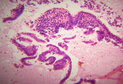 anticoncepcion_sangrado_uterino/diagnostico_endometrio_atrofico anticoncepcion_sangrado_uterino/diagnostico_endometrio_atrofico