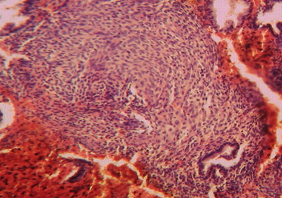 anticoncepcion_sangrado_uterino/diagnostico_endometritis_cronica anticoncepcion_sangrado_uterino/diagnostico_endometritis_cronica