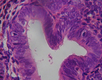 anticoncepcion_sangrado_uterino/diagnostico_hiperplasia_simple anticoncepcion_sangrado_uterino/diagnostico_hiperplasia_simple