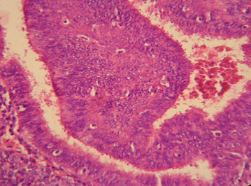 anticoncepcion_sangrado_uterino/hiperplasia_compleja_atipia anticoncepcion_sangrado_uterino/hiperplasia_compleja_atipia