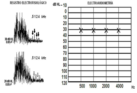 evaluacion_objetiva_audicion/anexo_2_electroaudiometria