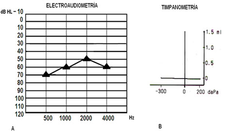 evaluacion_objetiva_audicion/anexo_3_electroaudiometria