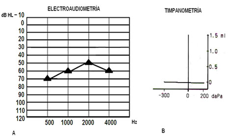evaluacion_objetiva_audicion/anexo_4_electroaudiometria