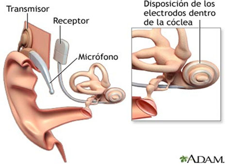 evaluacion_objetiva_audicion/anexo_6_implante