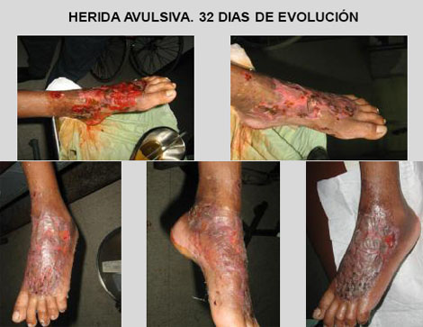 membrana_amnios_humano/foto_herida_avulsiva membrana_amnios_humano/foto_herida_avulsiva