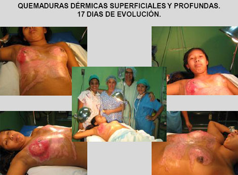 membrana_amnios_humano/foto_quemaduras_dermicas membrana_amnios_humano/foto_quemaduras_dermicas