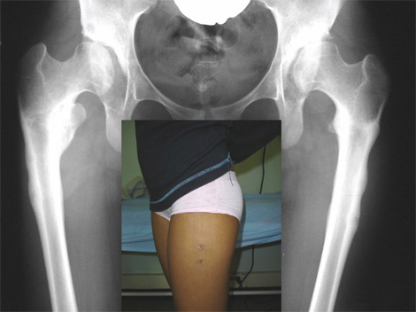 osteotomia_femoral_ortopedia/infantil_cicatrizacion