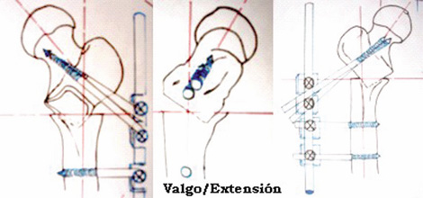 osteotomia_femoral_ortopedia/infantil_clavos_shans