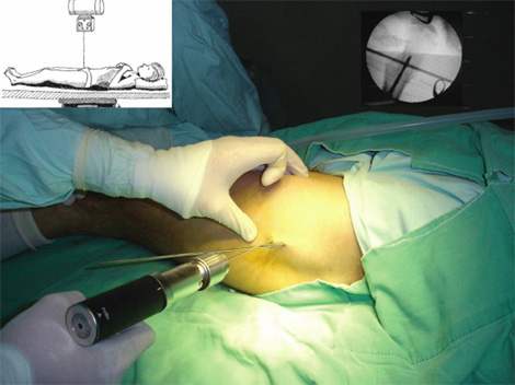 osteotomia_femoral_ortopedia/infantil_clavos_swan osteotomia_femoral_ortopedia/infantil_clavos_swan