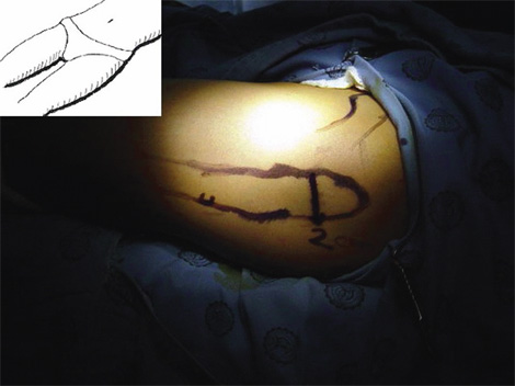 osteotomia_femoral_ortopedia/infantil_esquema_intraquirurgico osteotomia_femoral_ortopedia/infantil_esquema_intraquirurgico