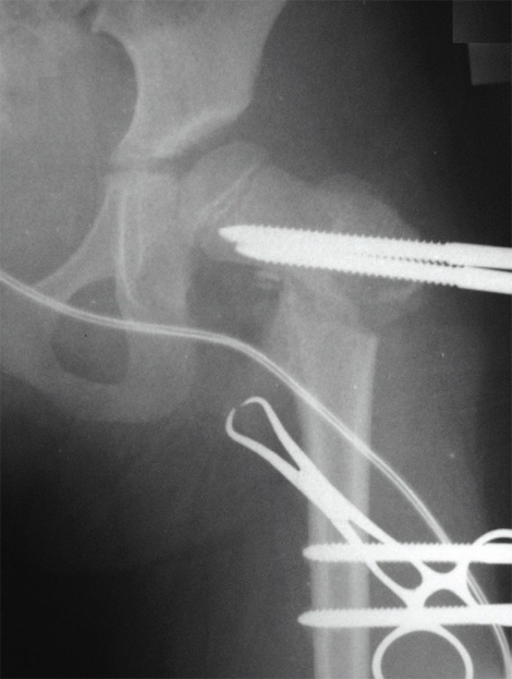 osteotomia_femoral_ortopedia/infantil_fijador_externo osteotomia_femoral_ortopedia/infantil_fijador_externo
