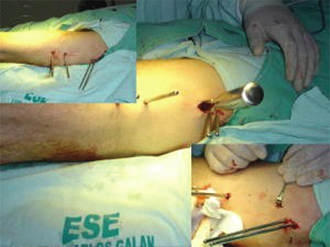 osteotomia_femoral_ortopedia/infantil_longitud_incision osteotomia_femoral_ortopedia/infantil_longitud_incision