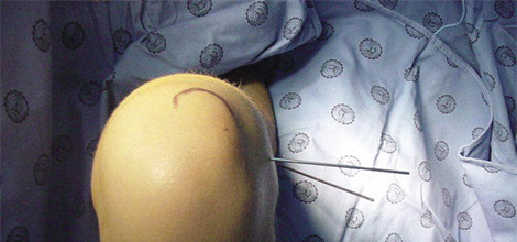 osteotomia_femoral_ortopedia/infantil_medicion