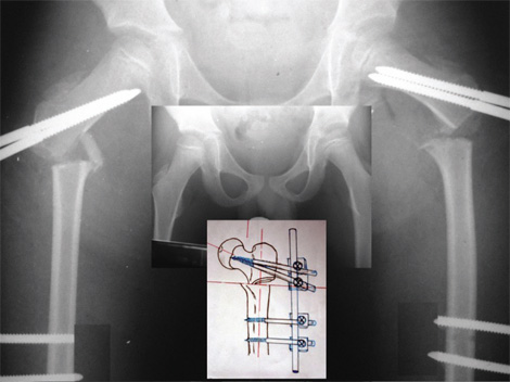 osteotomia_femoral_ortopedia/infantil_radiografia osteotomia_femoral_ortopedia/infantil_radiografia