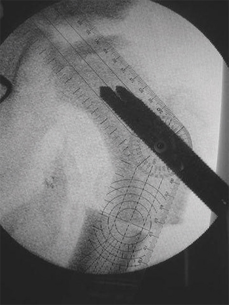 osteotomia_femoral_ortopedia/infantil_uroscopia