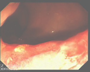 carcinoma_canal_anal/cancer_ano_endoscopia