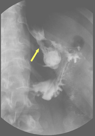 complicaciones_cirugia_bariatrica/fistula_reservorio_gastrica