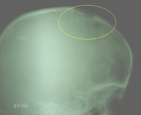 histiocitosis_caso_clinico/rx_lesiones_osteoliticas