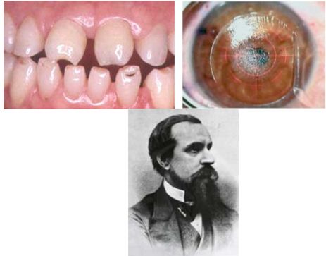 historia_enfermedades_venereas/dr_hutchinson