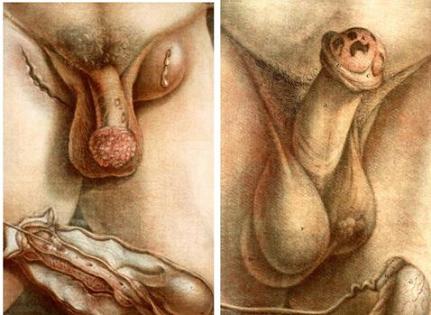 historia_enfermedades_venereas/ilustraciones_venereas historia_enfermedades_venereas/ilustraciones_venereas
