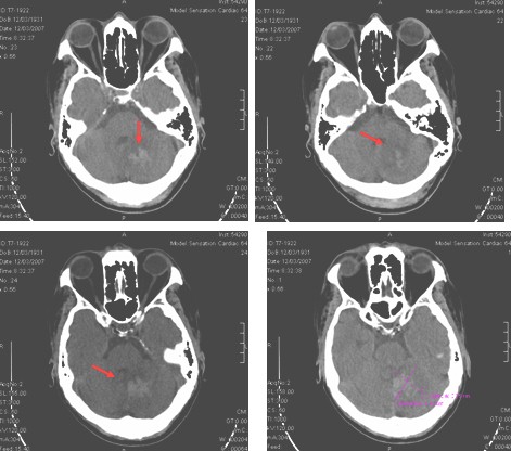 infarto_cerebeloso_caso/clinico_resonancia_magnetica_RMN