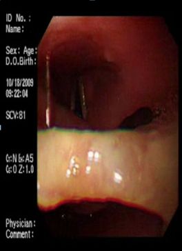 protesis_dental_esofago/hipofaringe_1