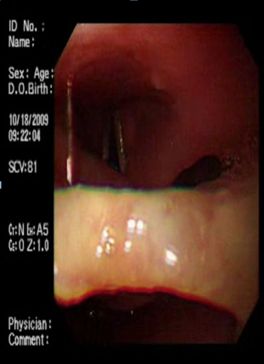protesis_dental_esofago/hipofaringe_1 protesis_dental_esofago/hipofaringe_1