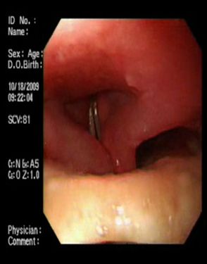 protesis_dental_esofago/hipofaringe_2 protesis_dental_esofago/hipofaringe_2