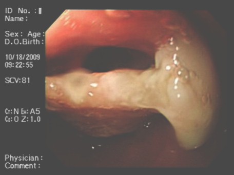 protesis_dental_esofago/hipofaringe_protesis protesis_dental_esofago/hipofaringe_protesis