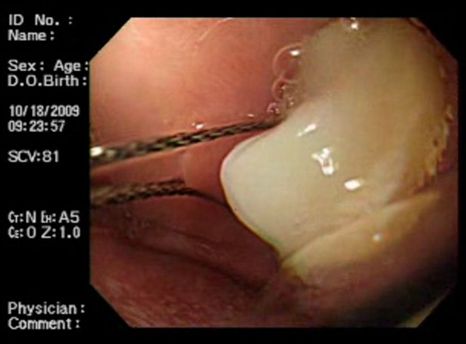 protesis_dental_esofago/intento_extraccion