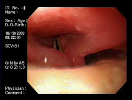 protesis_dental_esofago/protesis_cuerdas_vocales