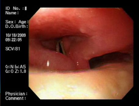 protesis_dental_esofago/protesis_cuerdas_vocales protesis_dental_esofago/protesis_cuerdas_vocales