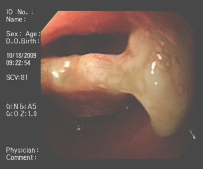 protesis_dental_esofago/salida_protesis protesis_dental_esofago/salida_protesis