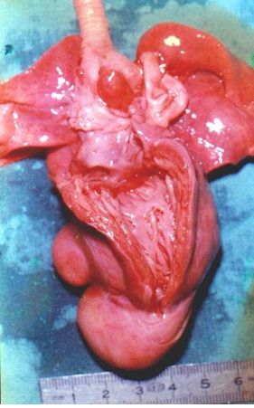 rabdomioma_cardiaco_neonato/autopsia_2 rabdomioma_cardiaco_neonato/autopsia_2
