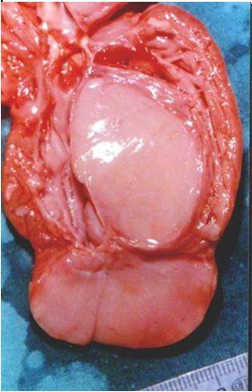 rabdomioma_cardiaco_neonato/autopsia_3 rabdomioma_cardiaco_neonato/autopsia_3